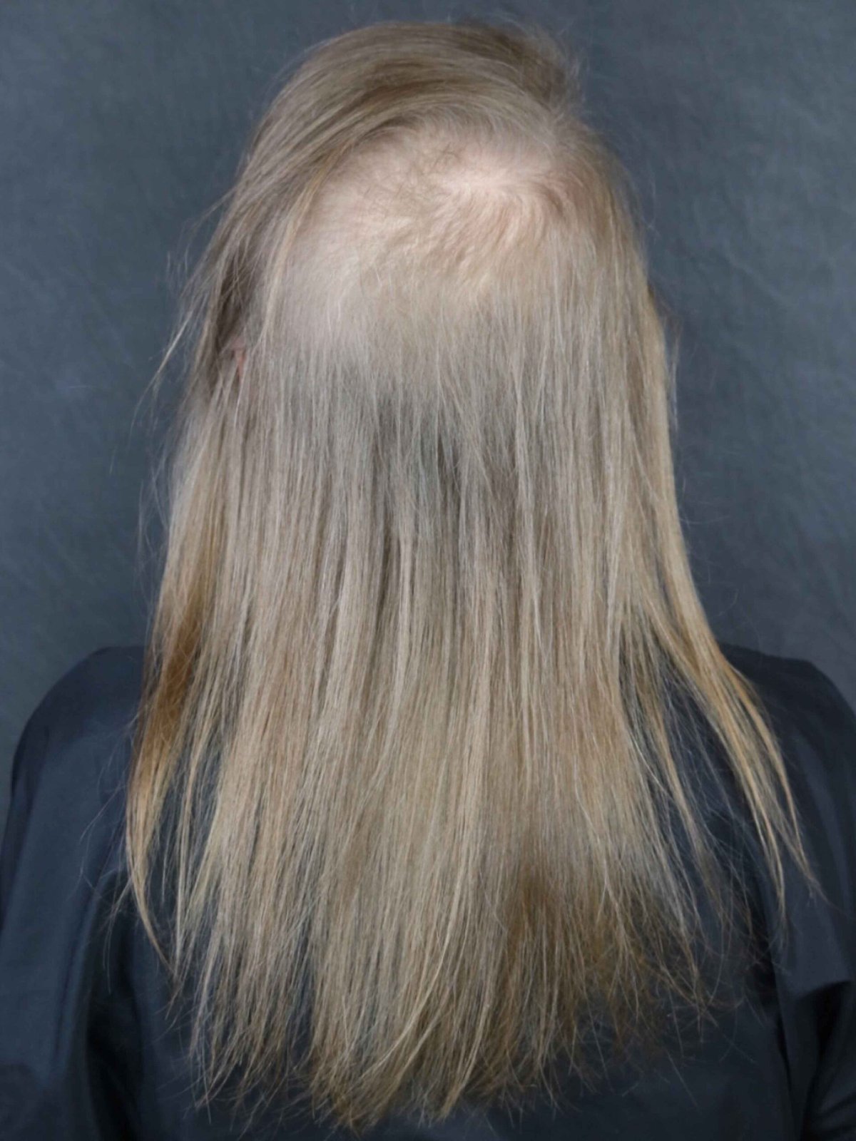 Back view of fine, see-through hair on top before her Garnish install